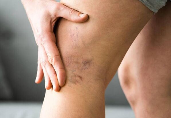 Levicose protects the legs from the development of varicose veins