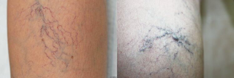 The symptoms of varicose veins