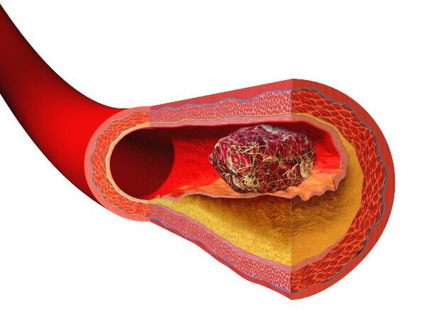 clot