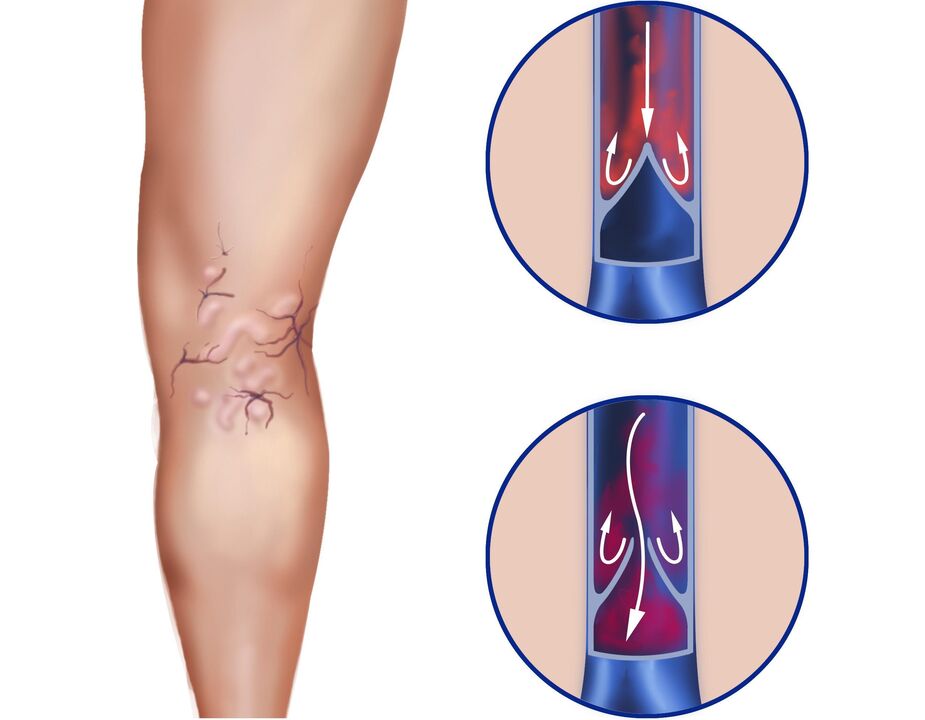 What happens to veins for varicose veins