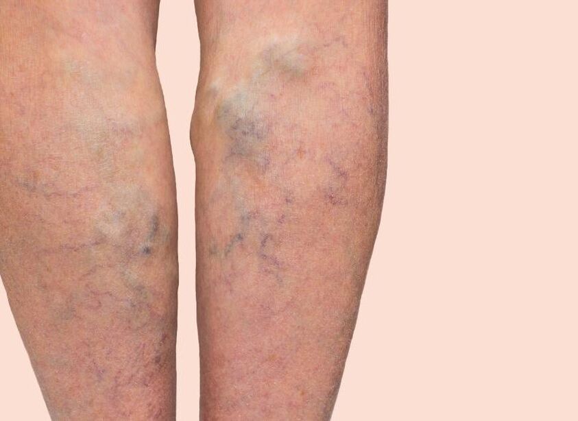 How the varicose veins look like