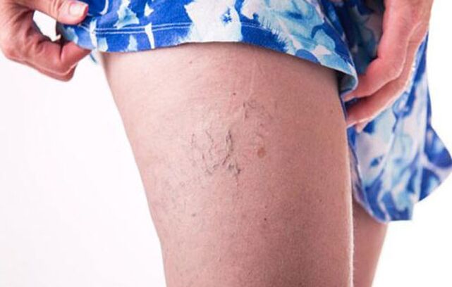 Varicose veins in the legs