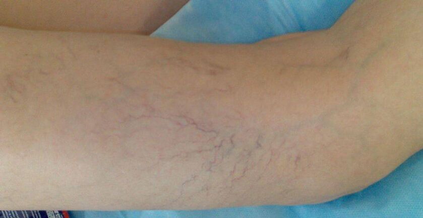 Vascular stars