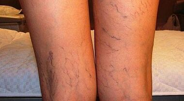 How to treat varicon expansion in women in women