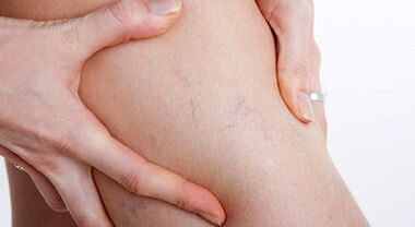 Signs and symptoms of varicose veins