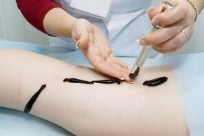 application of leeches for the treatment of varicose veins