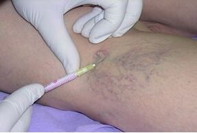 Sclerotherapy is a method for treating varicose veins in the legs