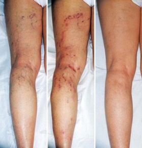 The result of the treatment of varicose veins of the lower extremities