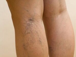 Veins that protrude from under the skin are a symptom of varicose veins in the legs