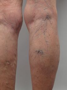 With varicose veins of the lower extremities, the twisted veins protrude above the surface of the skin