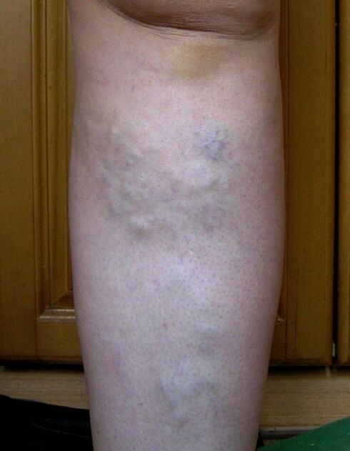 Swollen leg veins due to varicose veins